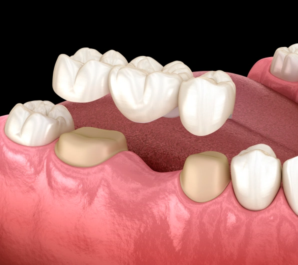 Dental Bridges
