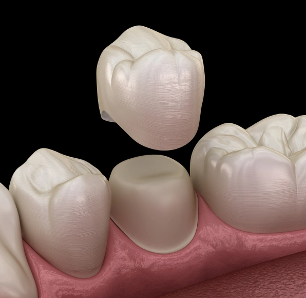 Dental Crowns