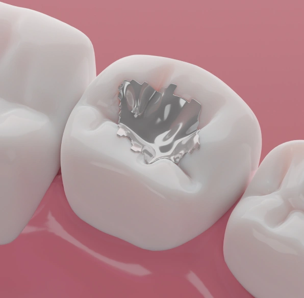 Dental Fillings