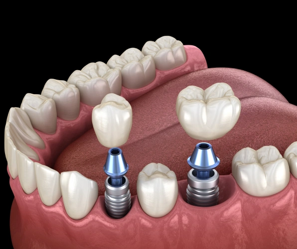 Dental Implants