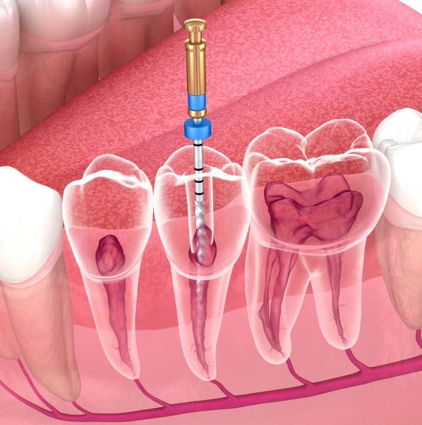 Full Mouth Rehabilitation