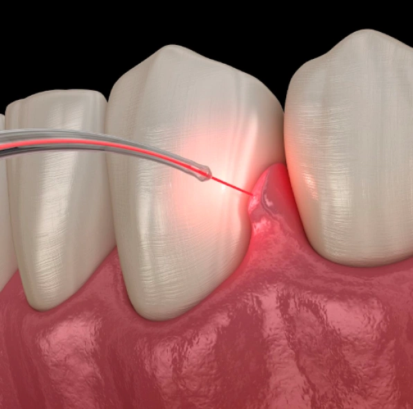 Laser Dentistry